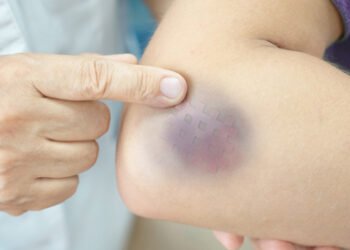 الكدمات العشوائية على الجسم.. ماذا تعني طبياً؟