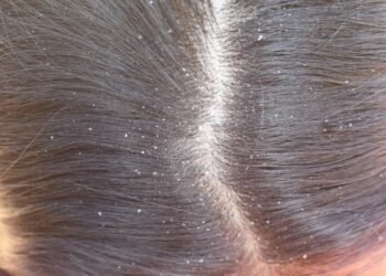 أسباب قشرة الشعر المستمرة عند النساء