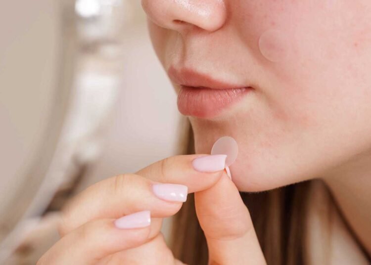 لصقات حب الشباب.. حل خفّي وفعال