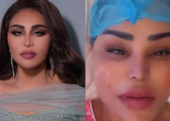 أحلام الشامسي تكشف عن إجراء تجميلي لشد الوجه